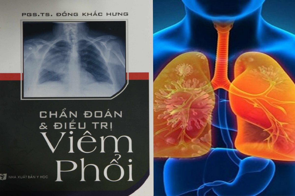 [TẢI PDF MIỄN PHÍ] Chẩn Đoán & Điều Trị Viêm Phổi – MyHanoi