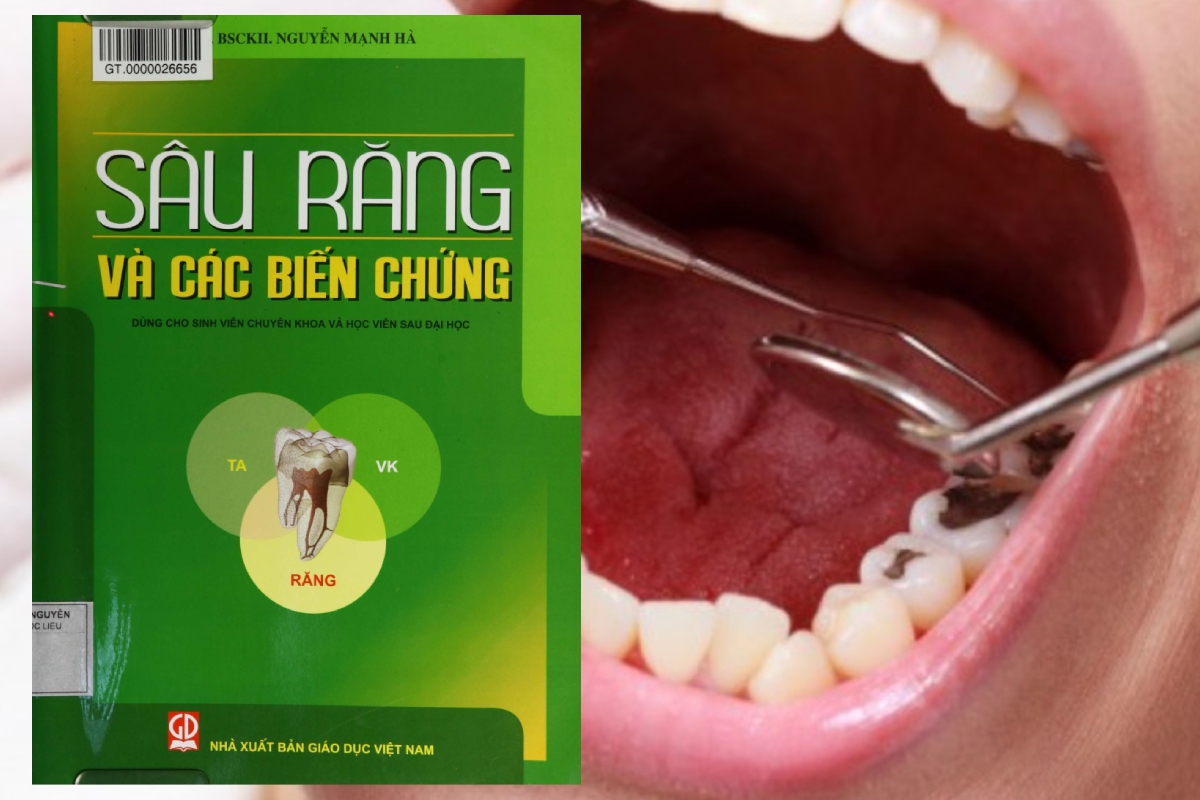 [TẢI PDF MIỄN PHÍ] Sâu răng và các biến chứng – Myhanoi